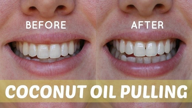 Coconut oil pulling